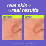 Dermalogica Clear Start Breakout Clearing Kit